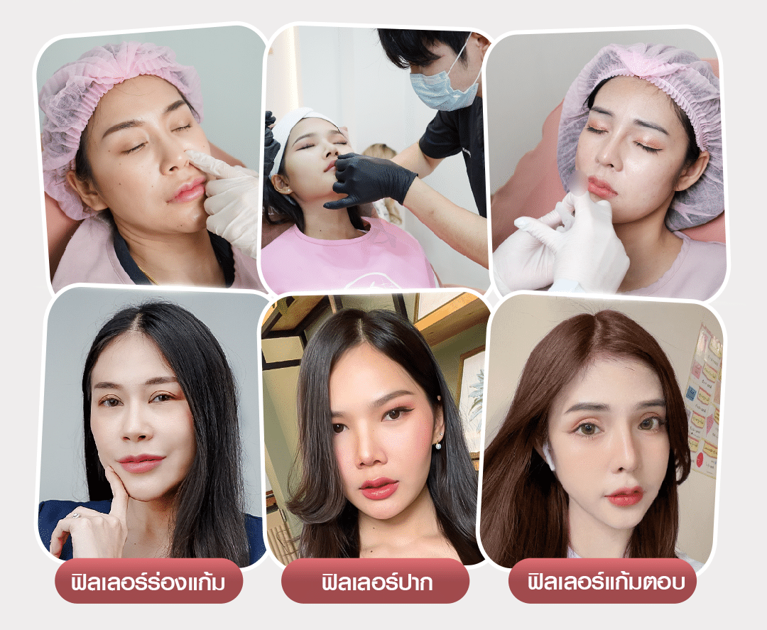 27-4-66-ADS-รวมฉีดฟิลเลอร์-e1685001778645