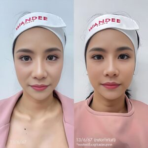 รีวิวฟิลเลอร์