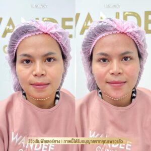 รีวิวฟิลเลอร์