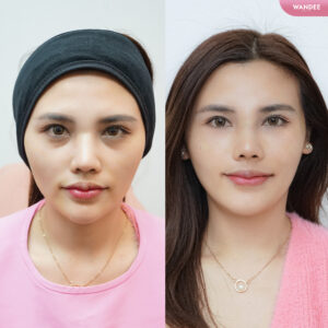 รีวิวฟิลเลอร์