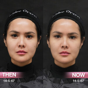 รีวิวฟิลเลอร์