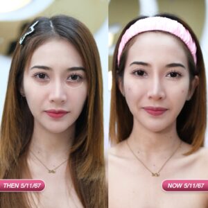 รีวิวฟิลเลอร์