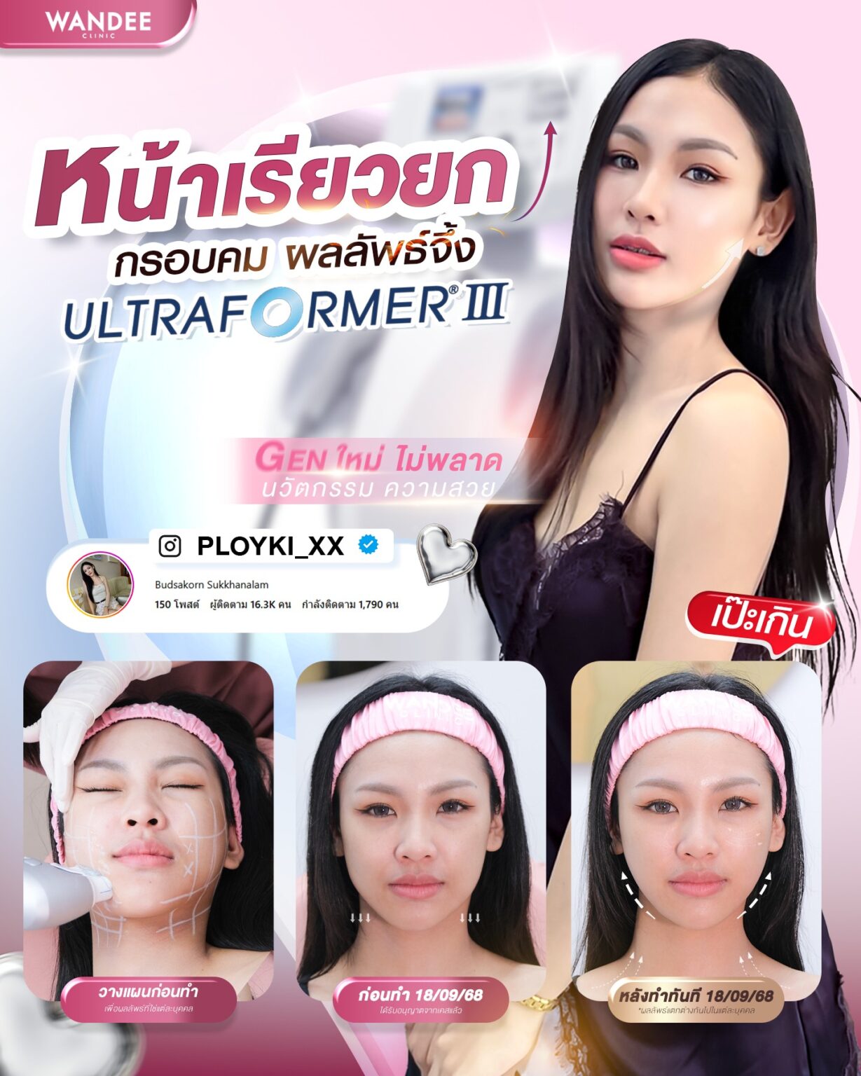 รีวิว Ultraformer-lll