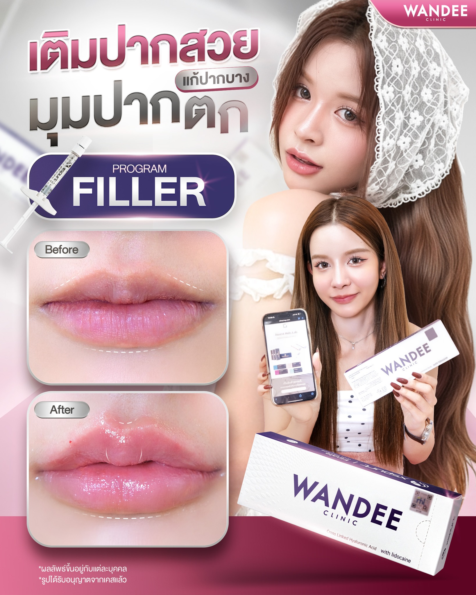 รีวิวฟิลเลอร์