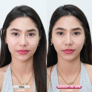 รีวิว Ultraformer-lll