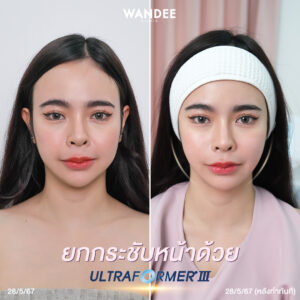 รีวิว Ultraformer-lll