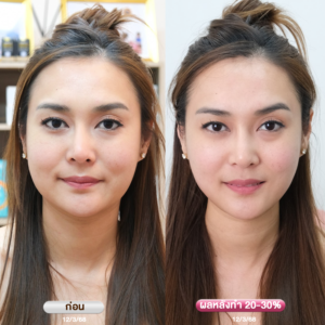 รีวิว Ultraformer-lll