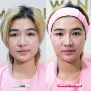 รีวิว Ultraformer-lll