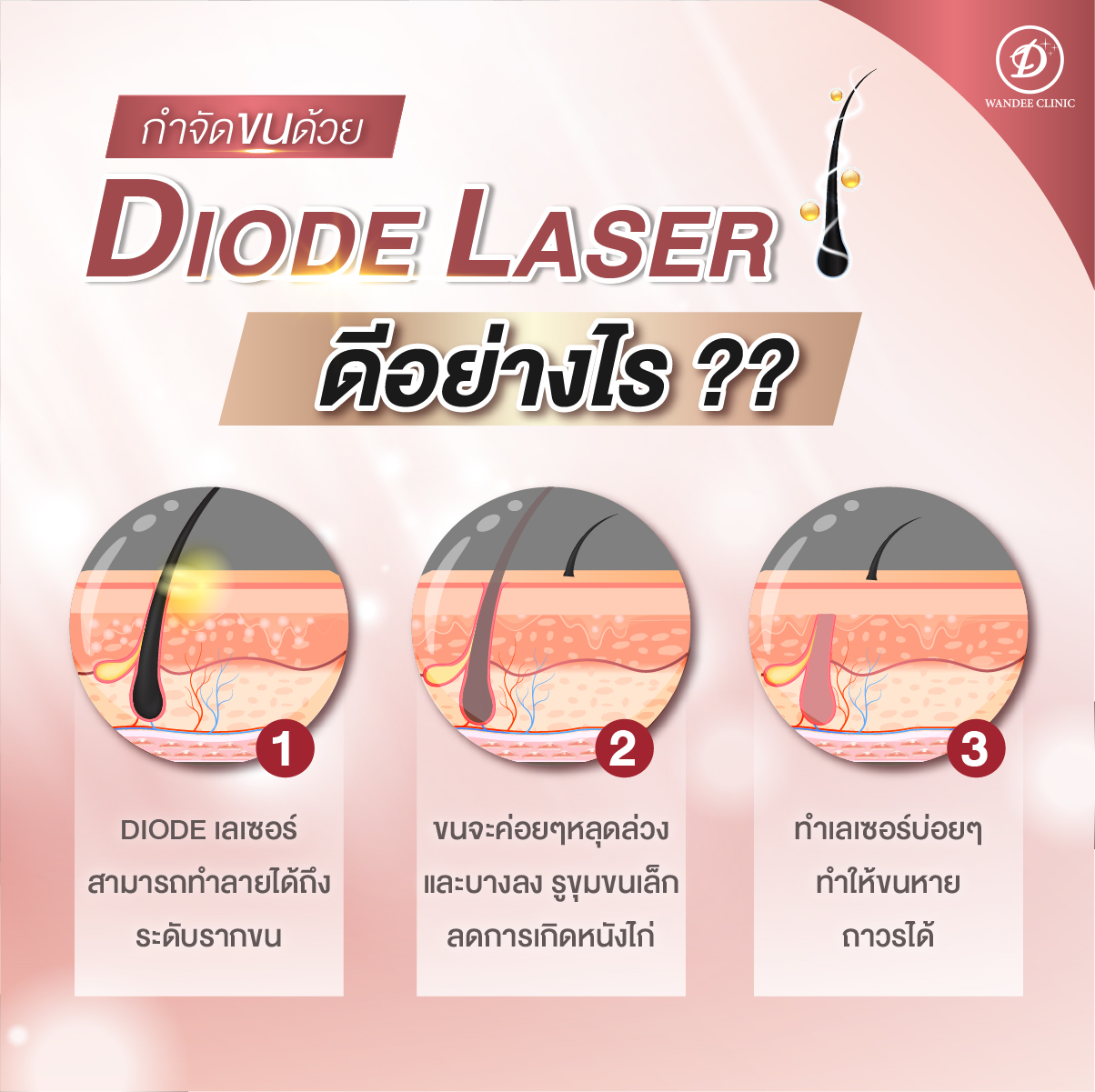 ข้อดี laser diod