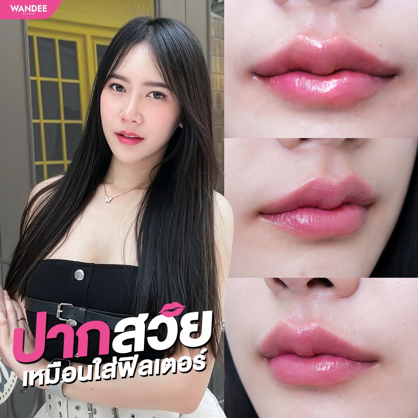 ฟิลเลอร์ปาก k.ครีมมี่