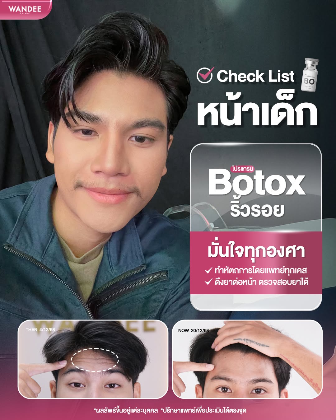 รีวิว bo ริ้วรอย