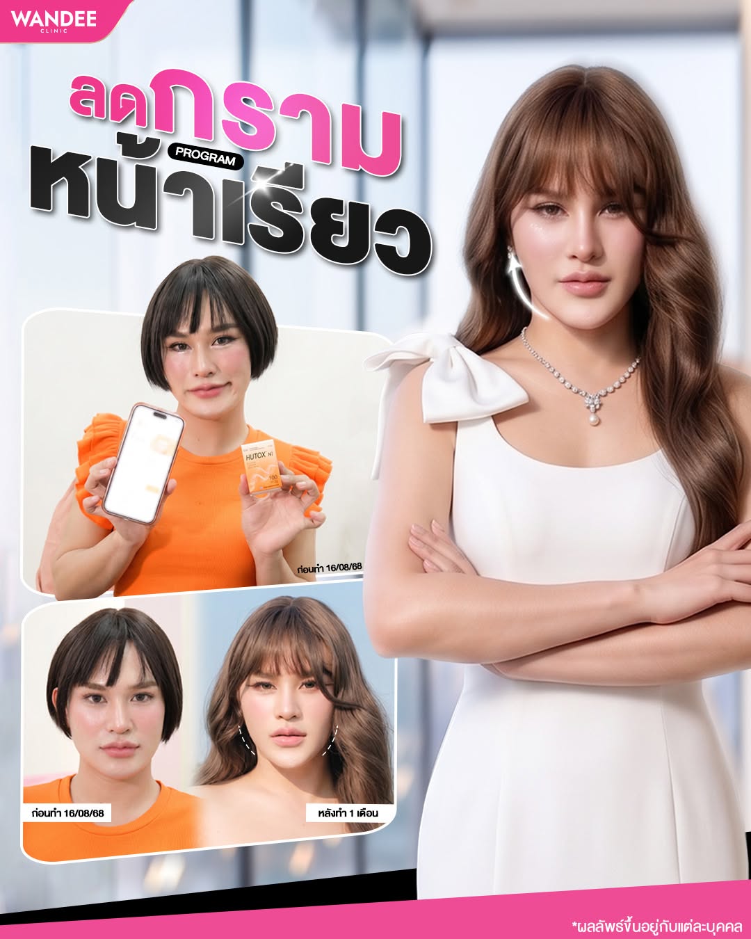 รีวิวโบท็อกซ์ ปังปอน
